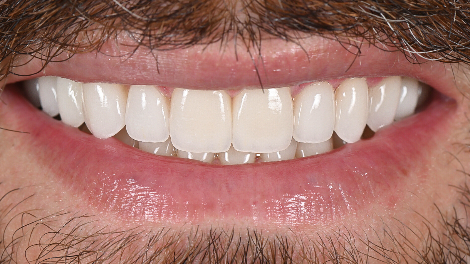 The same smile after composite bonding