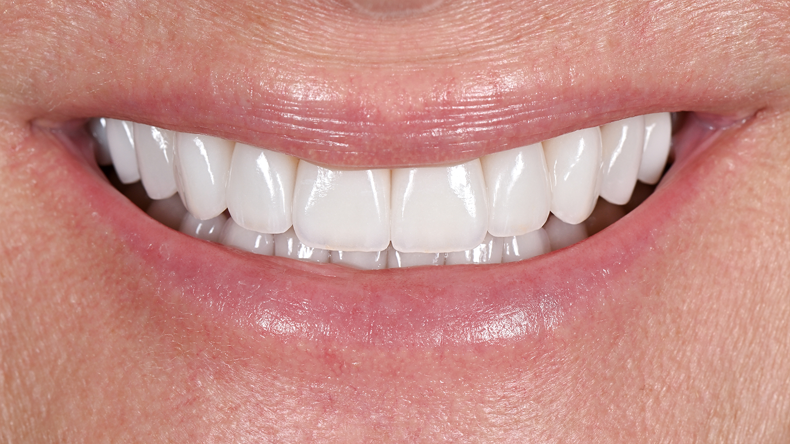 The same smile after whitening treatment