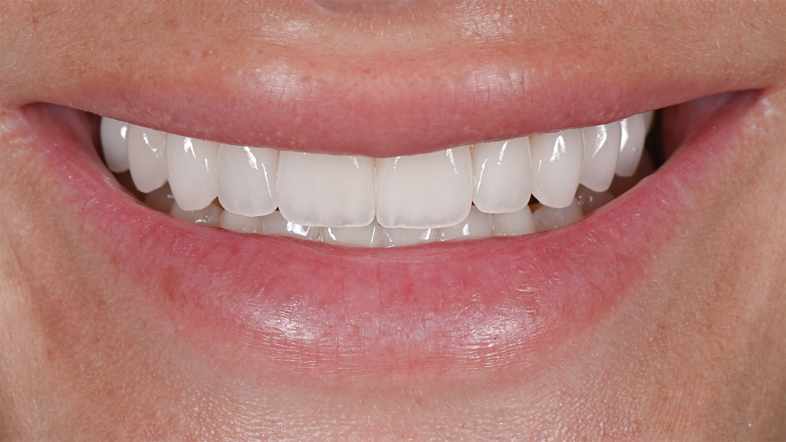 The same smile after clear aligner treatment