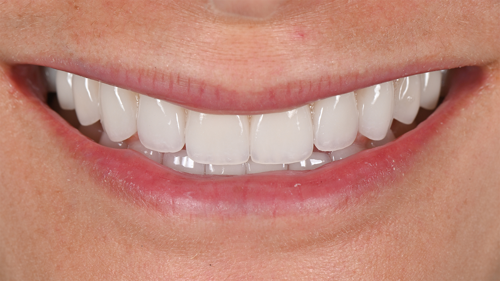 The same smile after cosmetic treatment