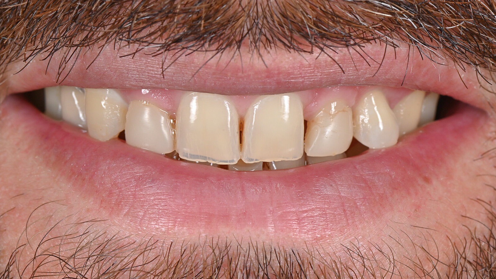 Teeth before composite bonding