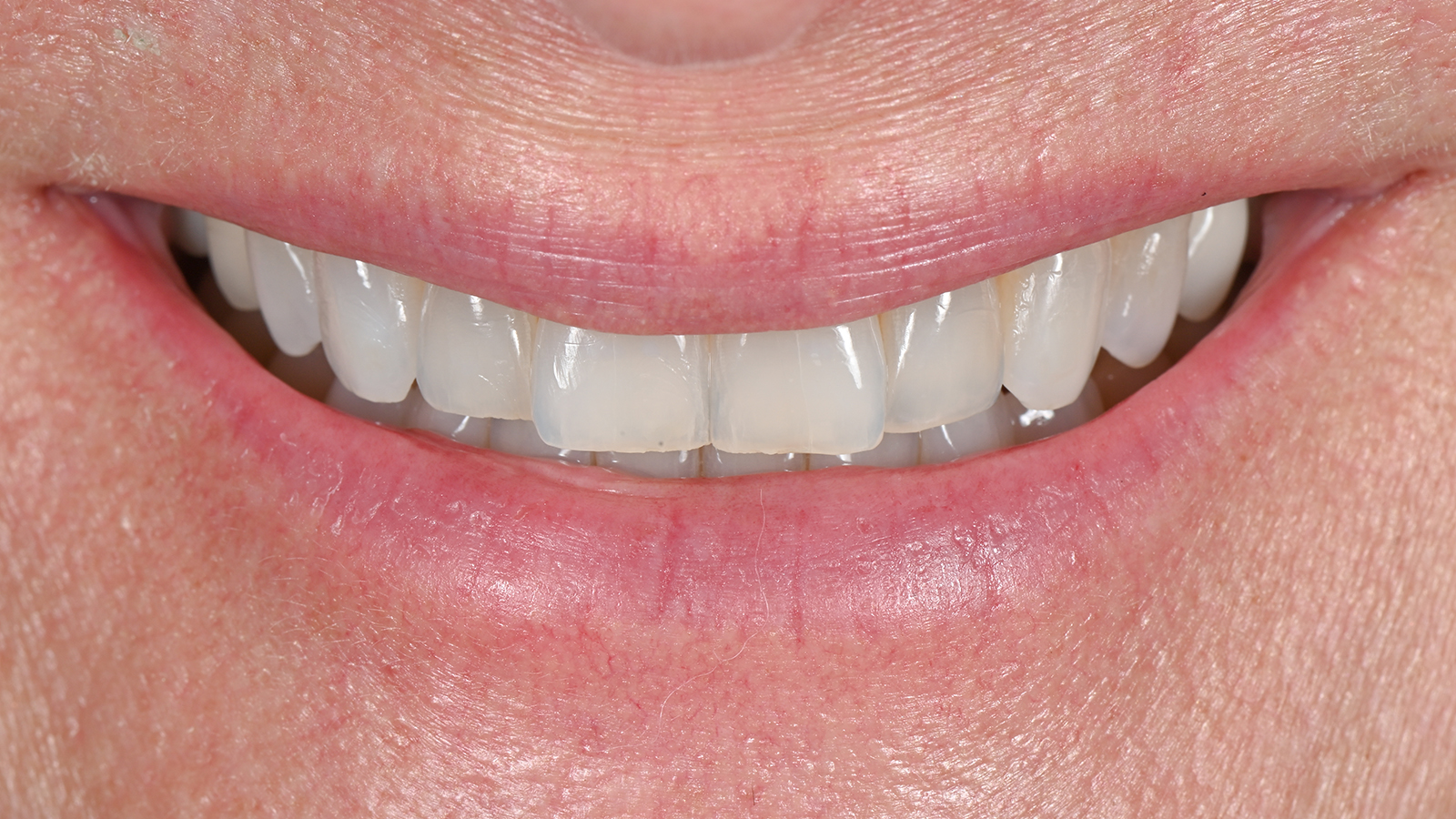 Teeth before whitening treatment