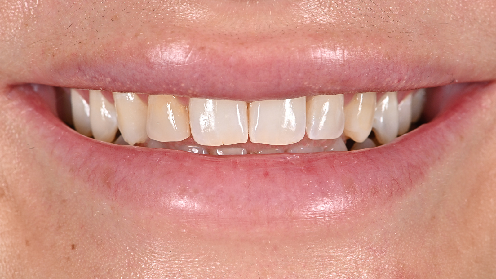Teeth before clear aligner treatment