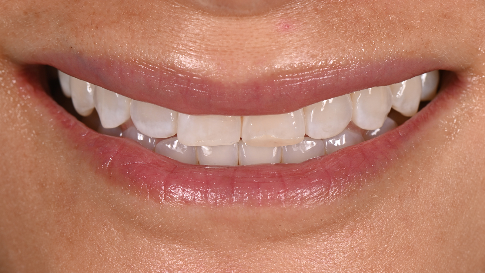 Teeth before cosmetic treatment